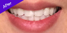 Teeth After Using BURST Oral Care